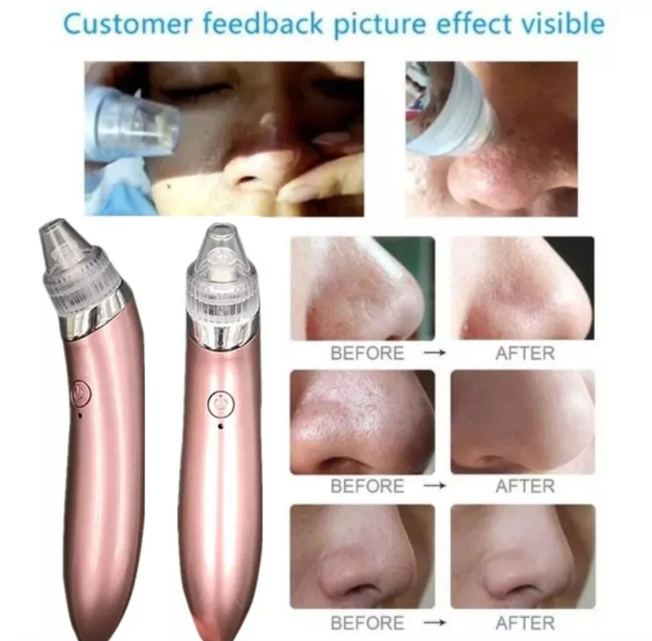 Vacuum Negative Pressure Acne Pore Cleaner - Model XN-8030